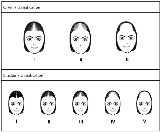 female-pattern-hair-loss