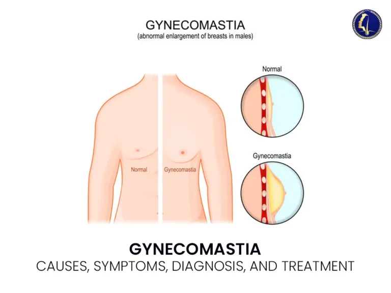 gynecomastia-medical