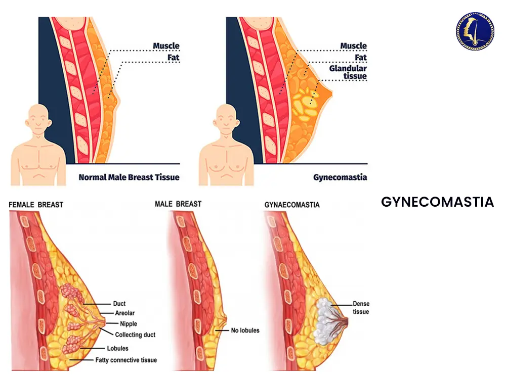 gynecomastia-medical-overview