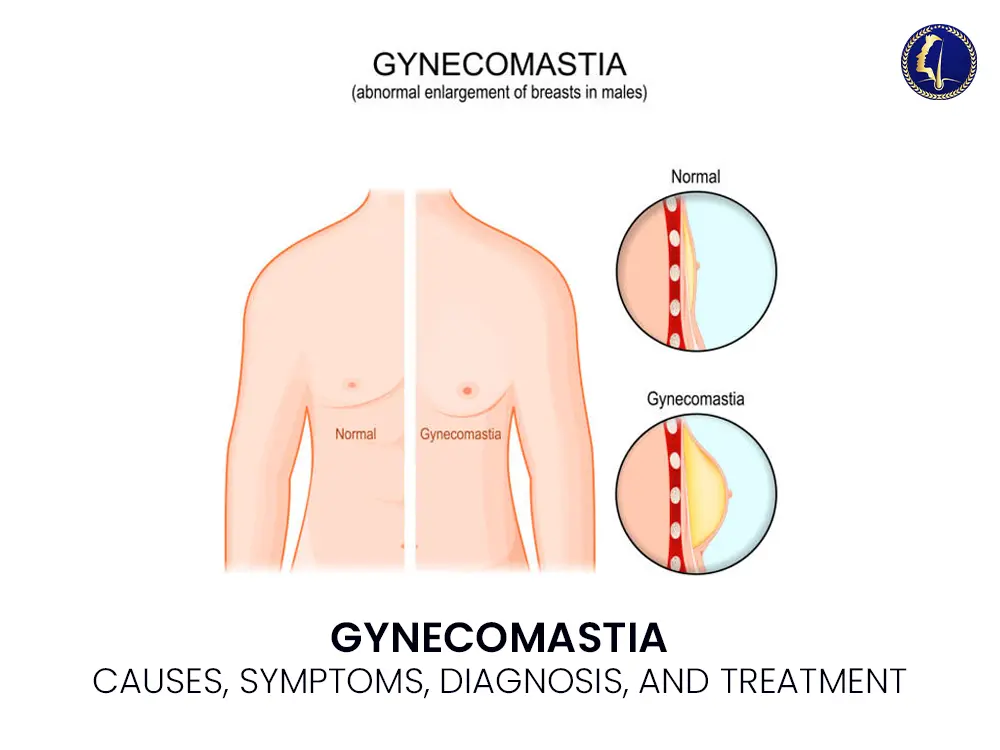 gynecomastia-medical