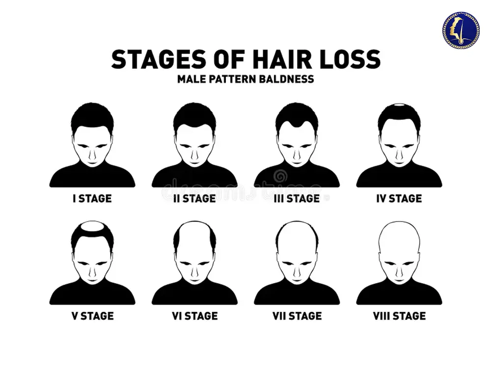 hair-loss-medical-guide-male-pattern-baldness