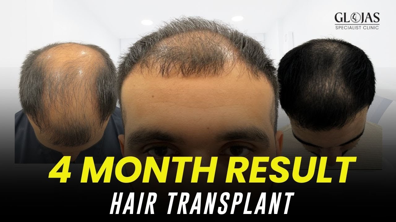 Hair Transplant in Malaysia | 3,500 Grafts for Diffuse Pattern Balding | 4-Month Update