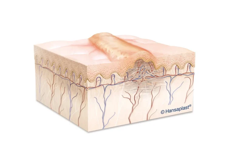 keloid-scars-treatment