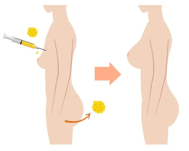 fat-transfer-surgery-malaysia