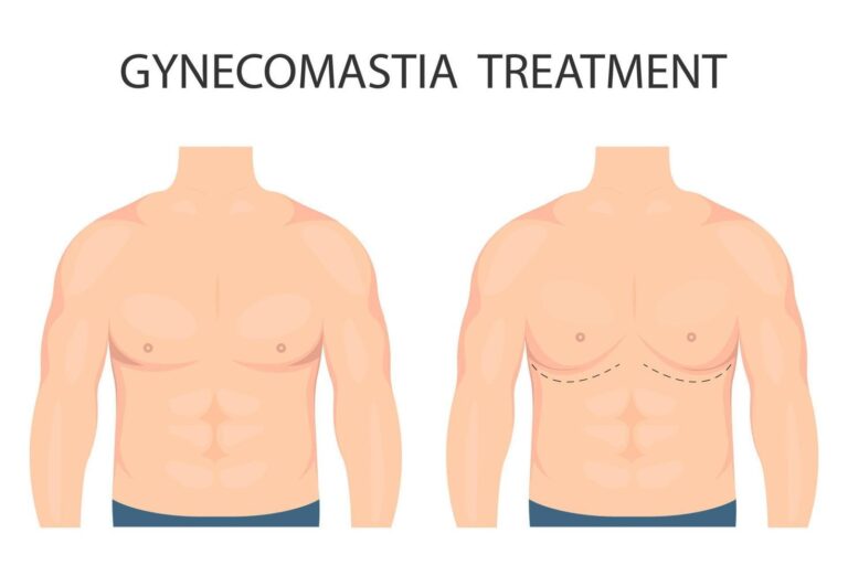 gynecomastia-surgery-malaysia-glojas-specialist-clinic