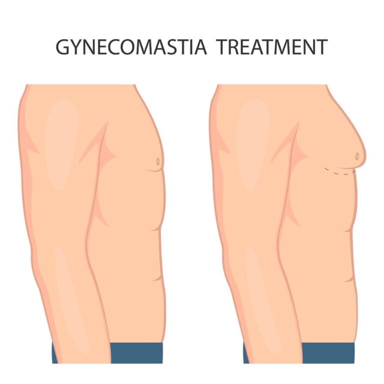 gynecomastia-surgery-malaysia-glojas-specialist-clinic-male-breast-reduction
