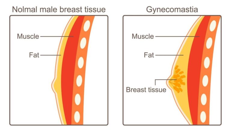 gynecomastia-surgery-malaysia-glojas-specialist-clinic-male-breast-reduction