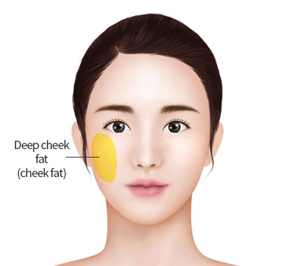 buccal-fat-removal