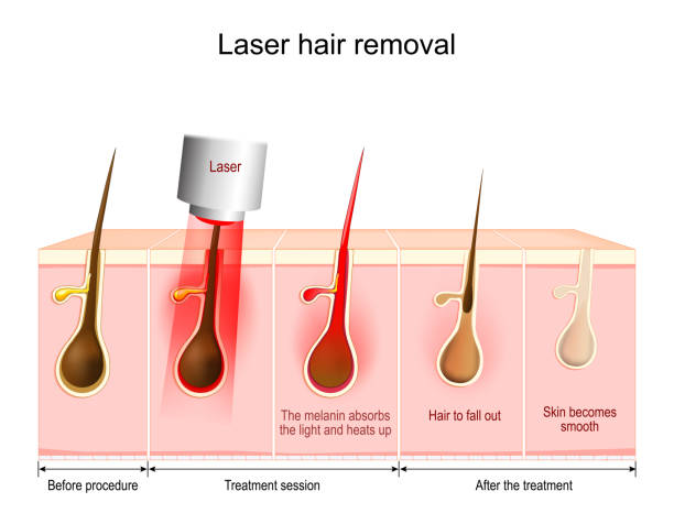 permanent-laser-hair-removal-kuala-lumpur-malaysia