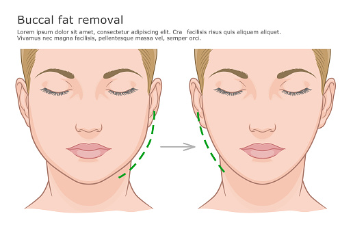 buccal-fat-removal-malaysia