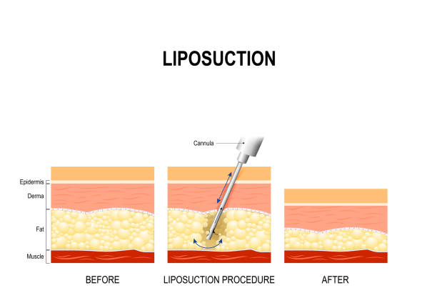liposuction-malaysia