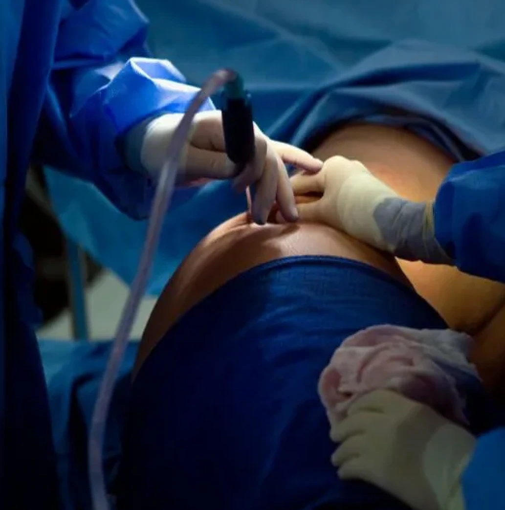 fat-lipo-malaysia