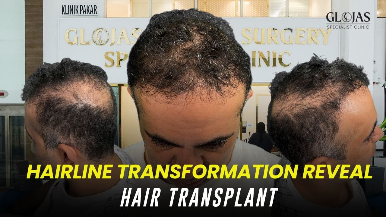 Crown Hair Transplant – Australian Patient Hair Transplant Journey | 2,500 Grafts by Prof. Dr. Jas