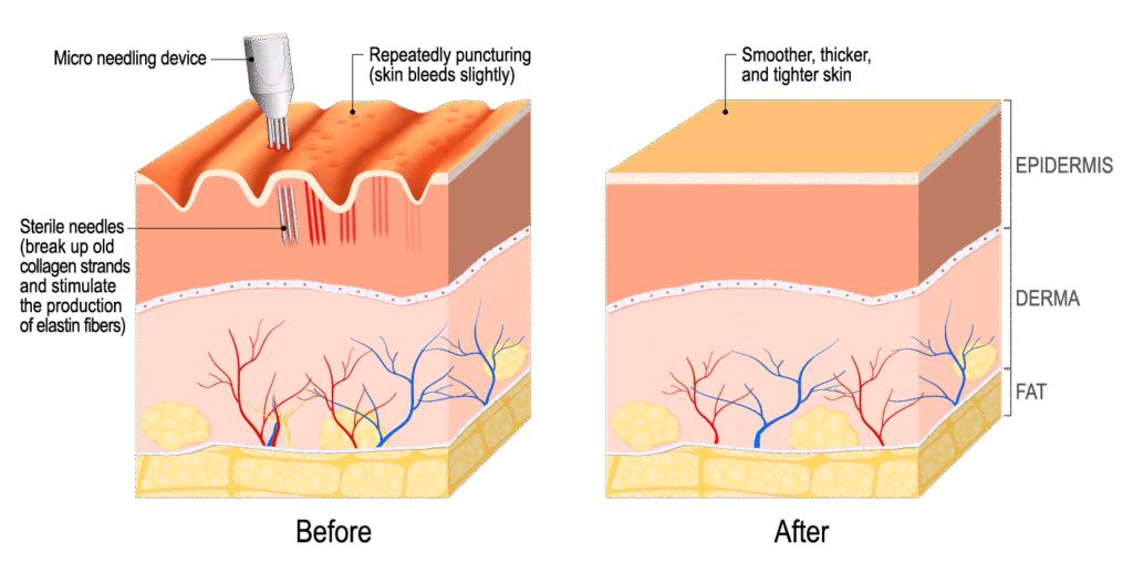 microneedling-before-and-after