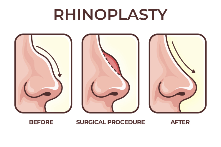 rhinoplasty-surgery-malaysia-nose-reshaping-surgery