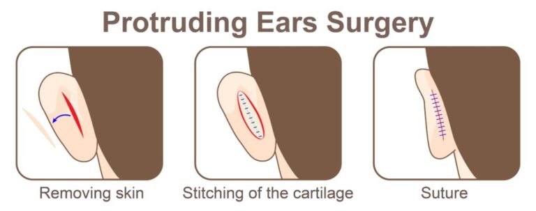 otoplasty-surgery-malaysia-glojas-clinic