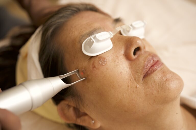 pico-laser-treatment-picosure-laser-q-switch-laser