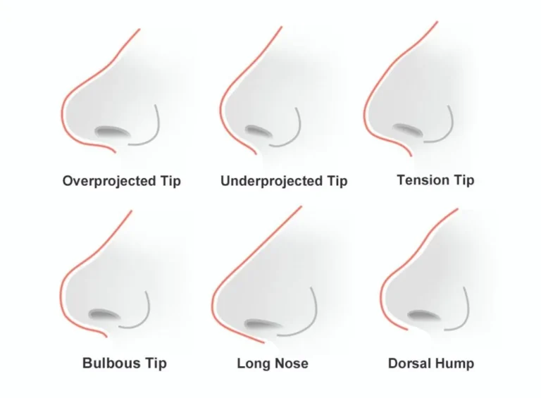 rhinoplasty-surgery-malaysia