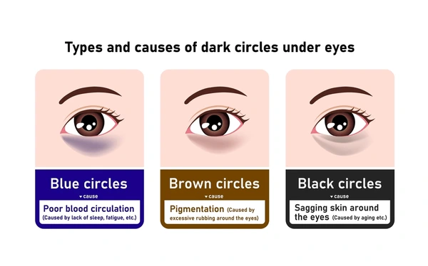 6 Cara Hilangkan Hitam Bawah Mata Secara Berkesan & Efektif 1 hitam-bawah-mata-dark-circles
