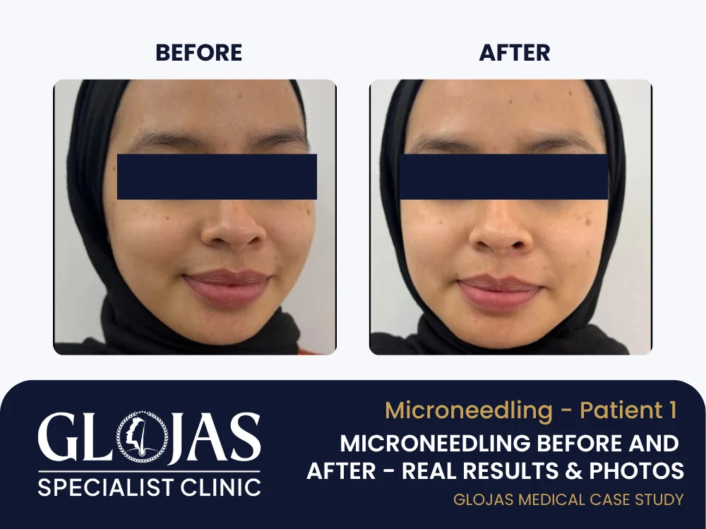 Microneedling Before and After – Real Results & Photos, Benefits & What to Expect