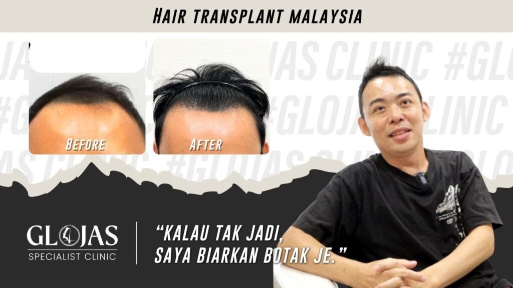 𝐇𝐚𝐢𝐫 𝐓𝐫𝐚𝐧𝐬𝐩𝐥𝐚𝐧𝐭 Malaysia | Tanam Rambut: Transformasi Selepas 1 Tahun 28 tanam-rambut