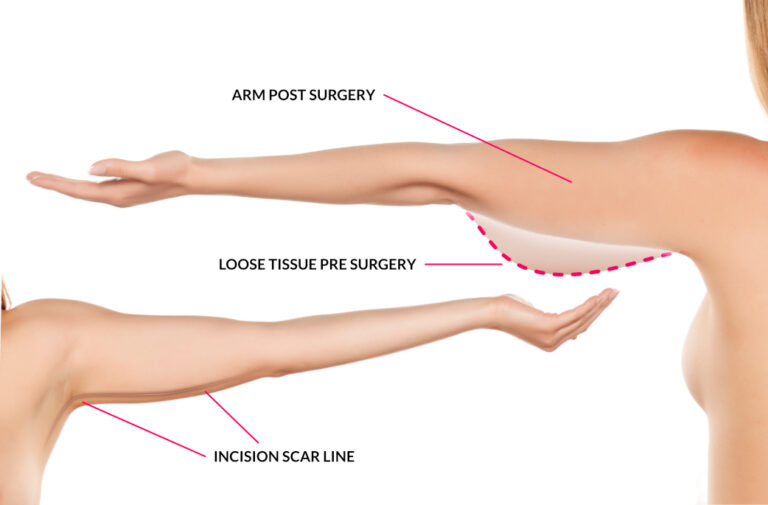 exilis-treatment-skin-tightening-malaysia