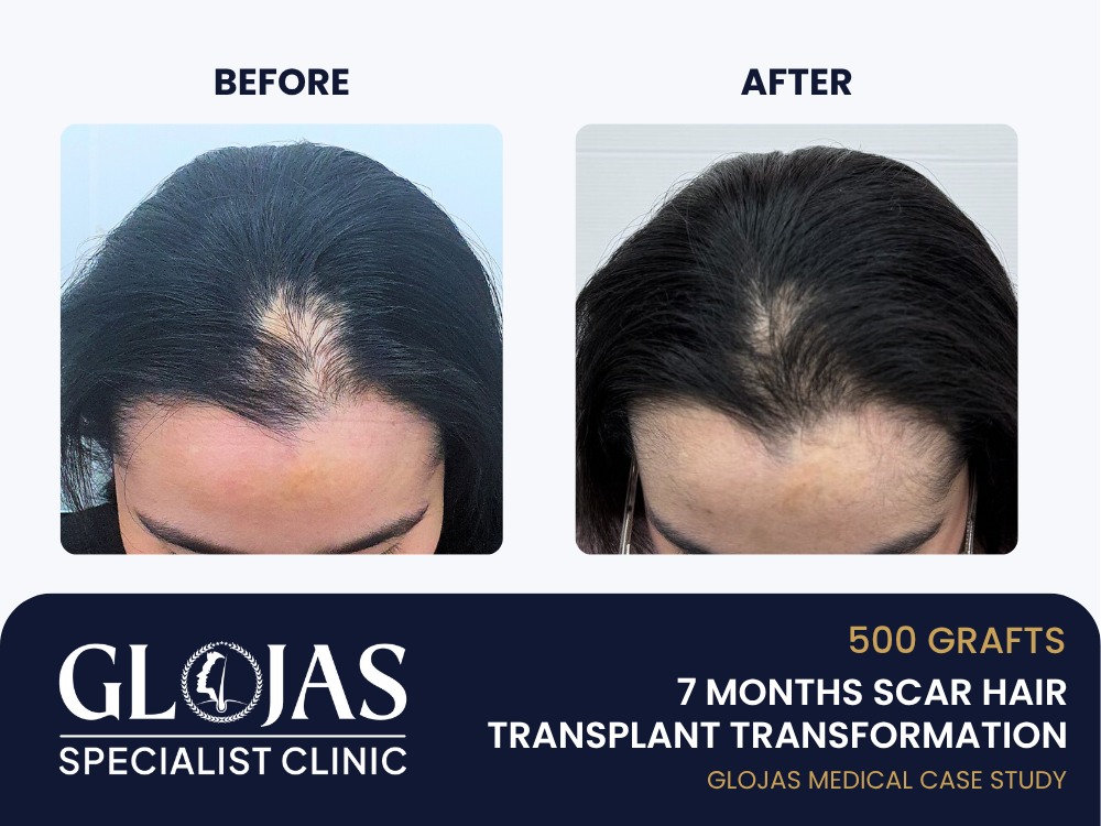 Kajian Kes: Tanam Rambut – 500 Graft untuk Parut Melecur di Kulit Kepala (Hasil 7 Bulan)