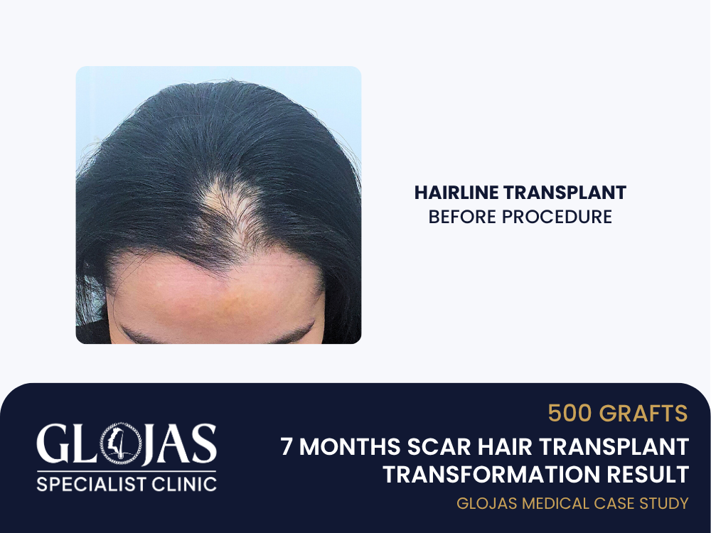 scar-hair-transplant-before