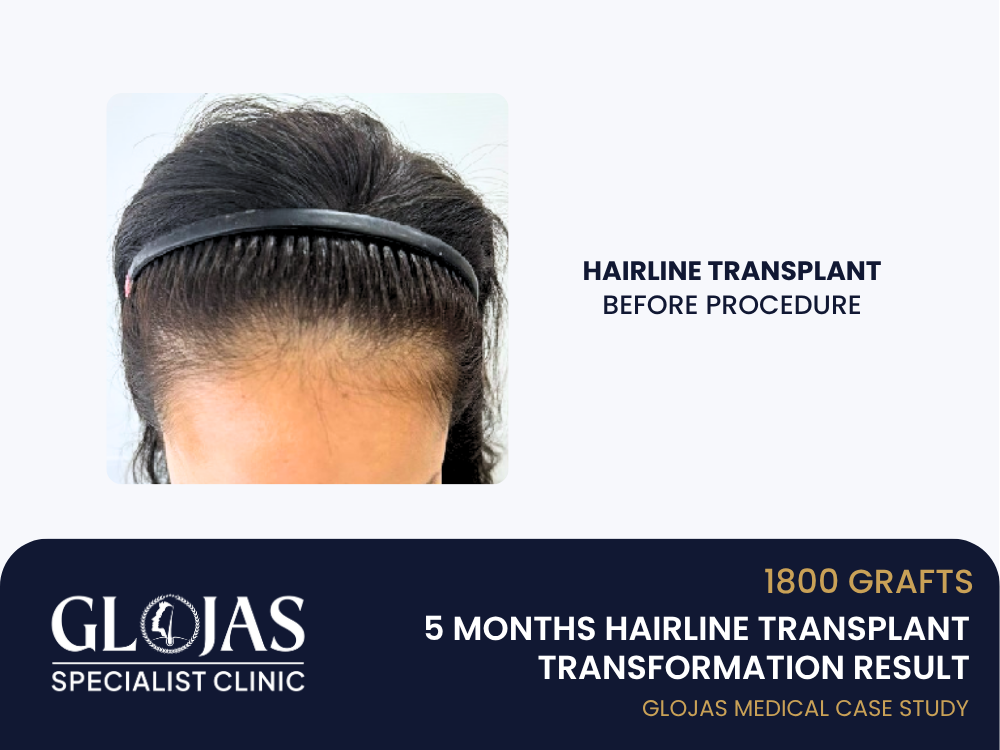 hairline-lowering-before