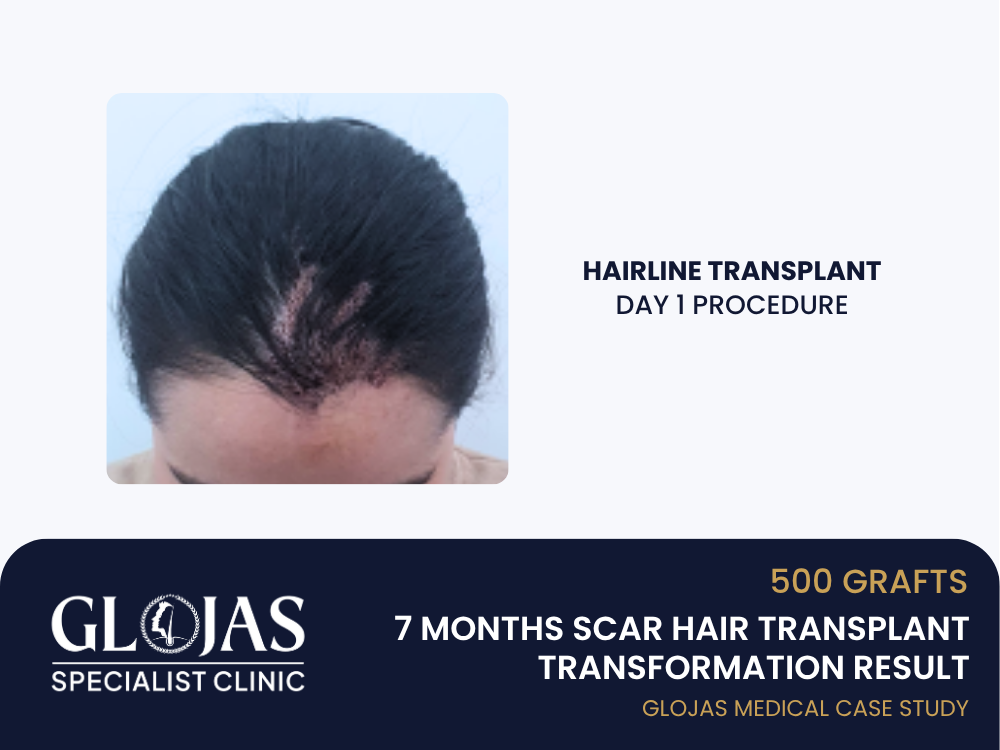 scar-hair-transplant-day-1