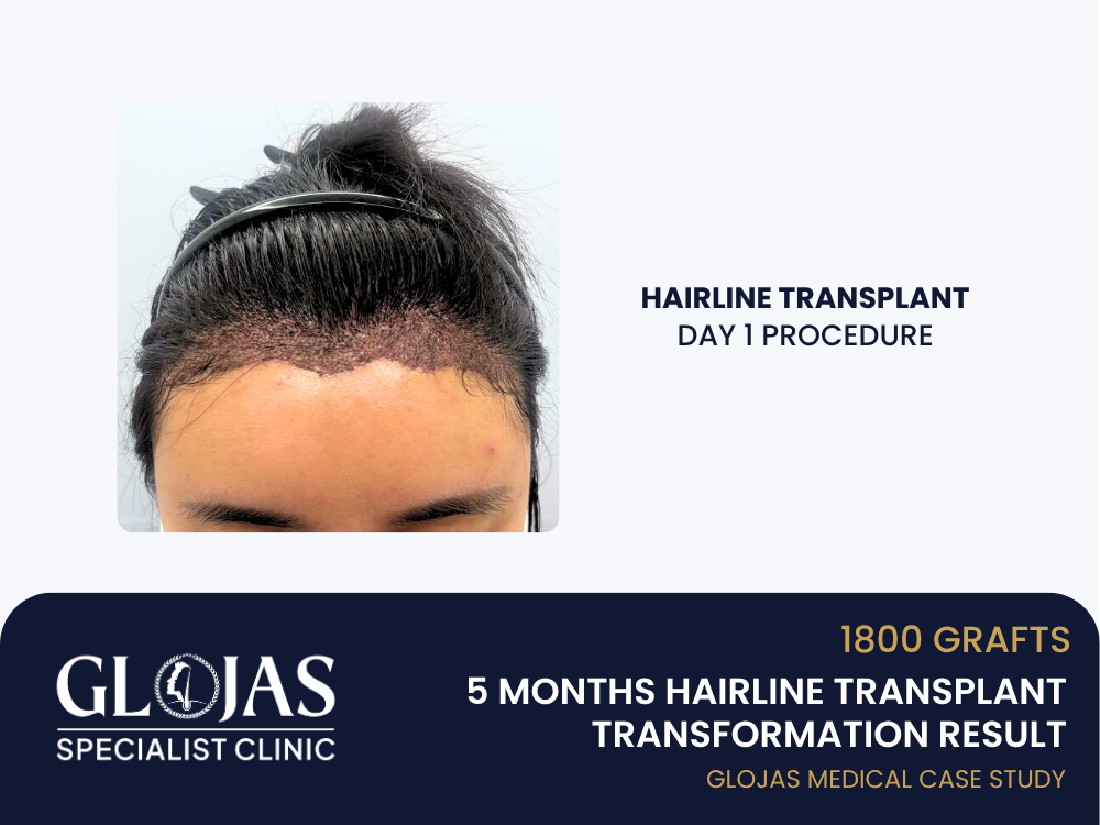 hairline-lowering-day-1