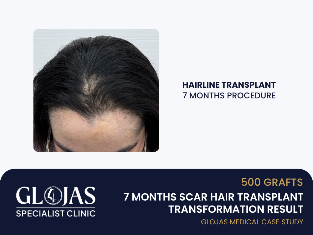 scar-hair-transplant