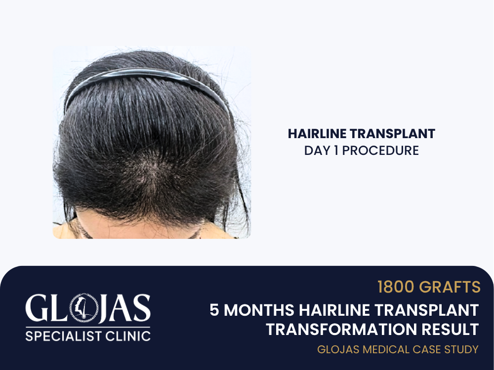 hairline-lowering-5-months