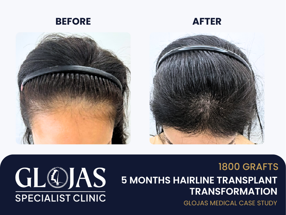Kajian Kes: Tanam Rambut – 1,800 Graft untuk Turunkan Garisan Rambut (Hasil 5 Bulan)