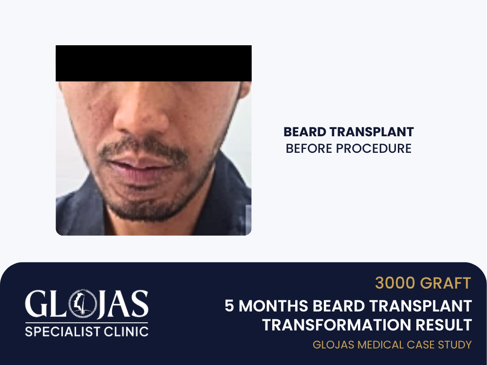 beard-transplant-before