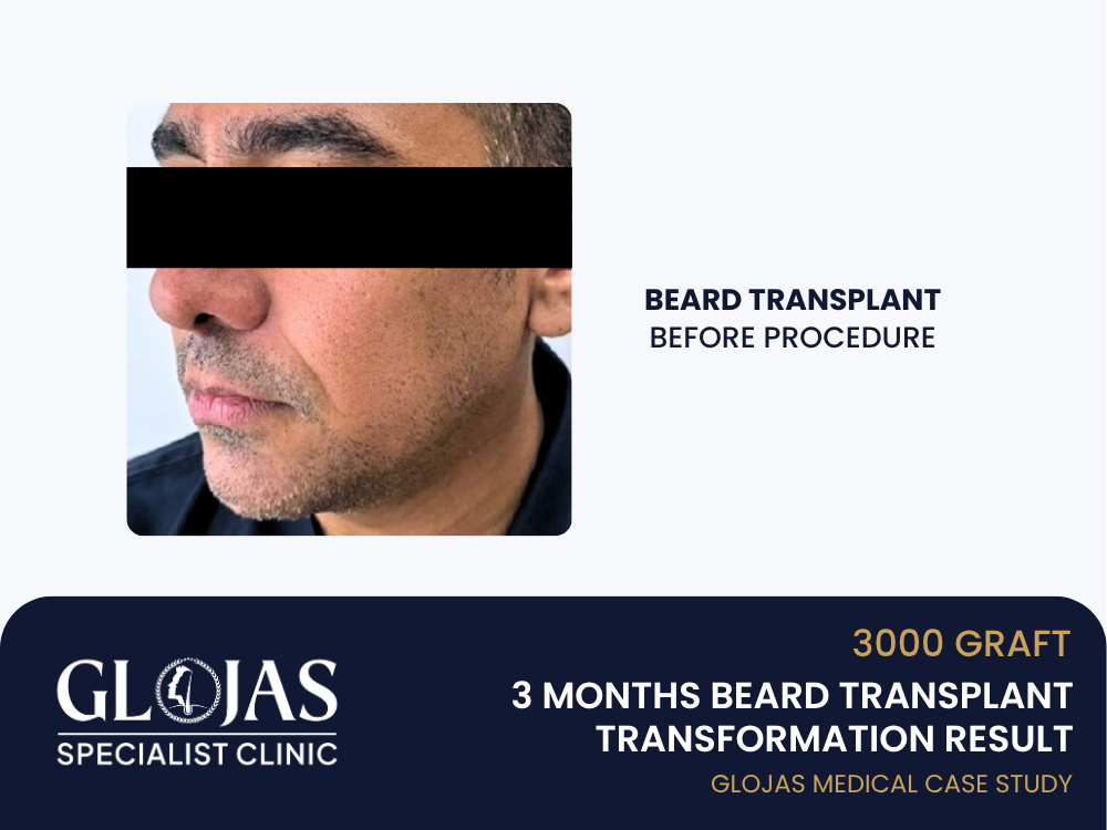 beard-transplant-sebelum