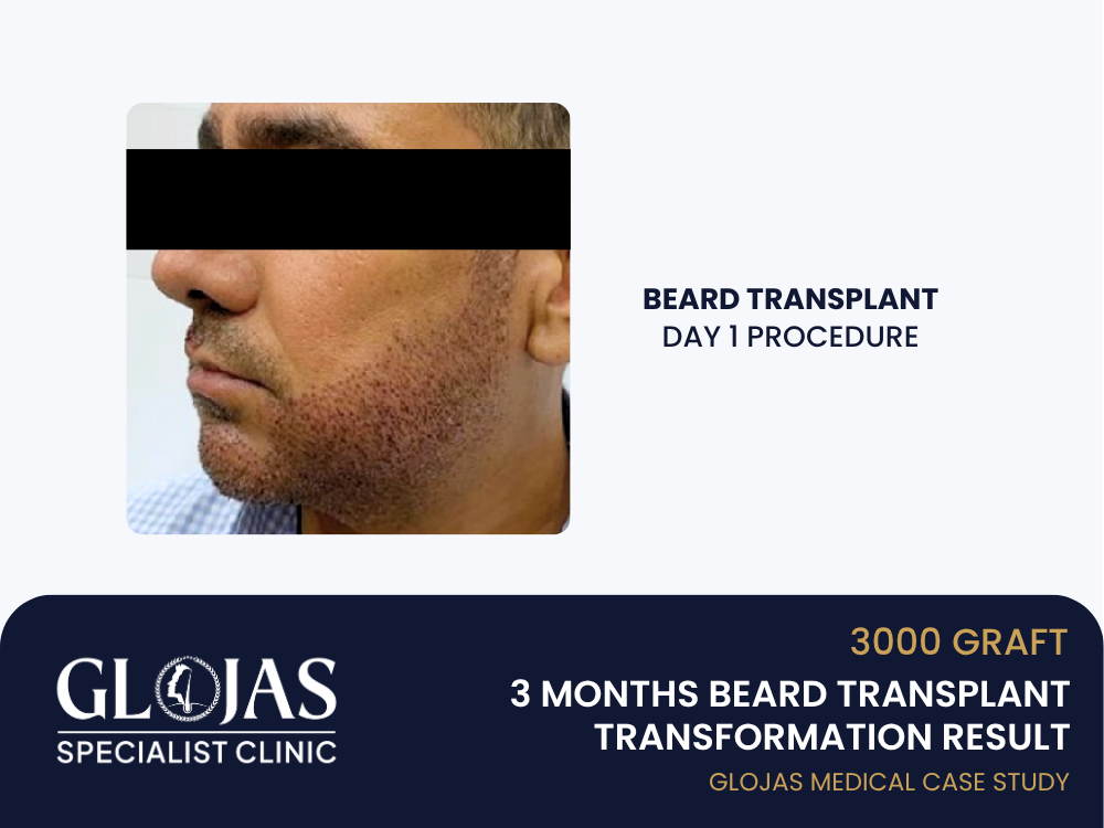 beard-transplant-day-1
