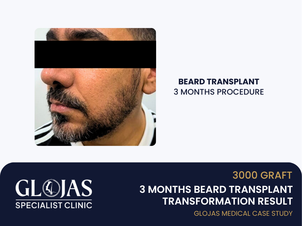 beard-transplant-3-months