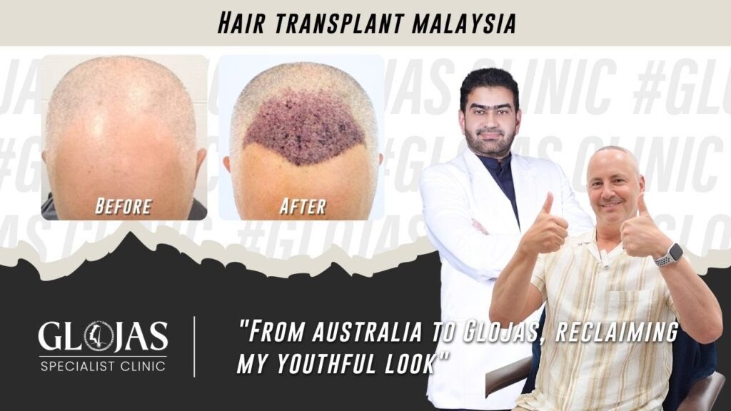 Hair Transplant in Malaysia | Best Results & Cost | Australian Patient's Hair Transplant Journey 22 hair-transplant