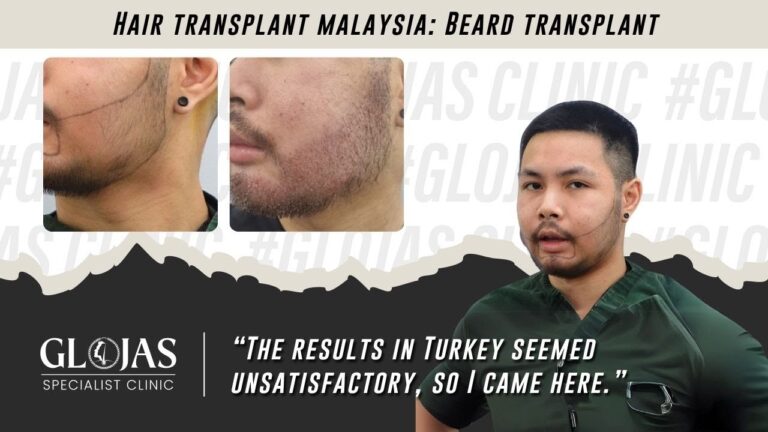 beard-transplant