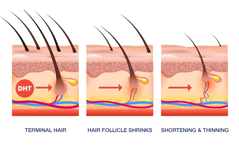hair-loss-causes-DHT