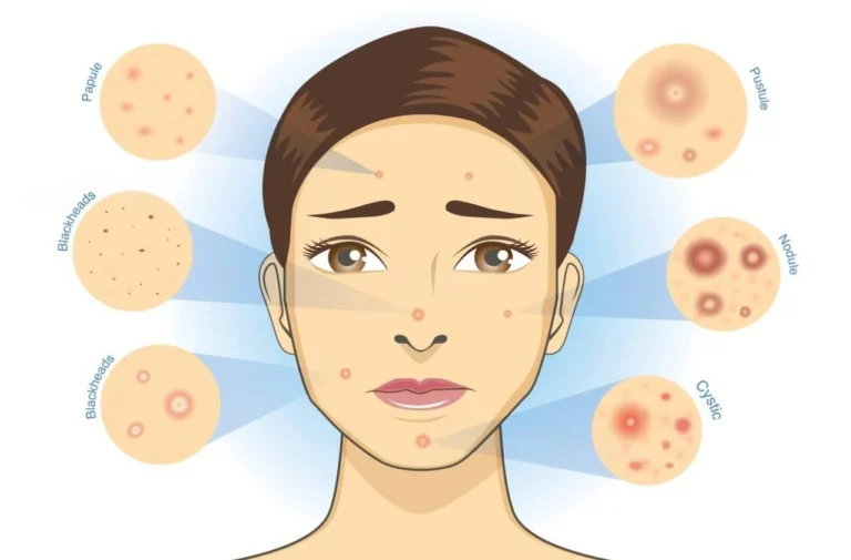 prp-face-injection-acne-dull-skin