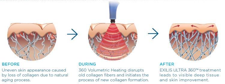 exilis-treatment-skin-tightening-malaysia