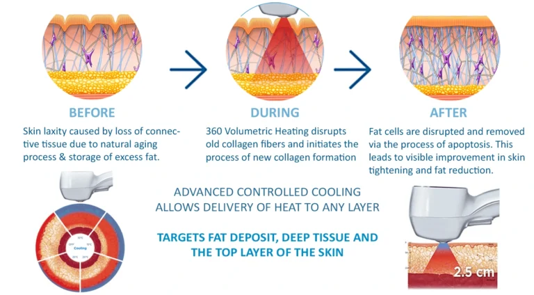 exilis-treatment-skin-tightening-malaysia