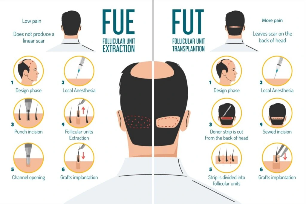 FUE vs FUT: Which Hair Transplant Technique Is Right in Malaysia? 1 FUE vs FUT: Which Hair Transplant Technique Is Right?