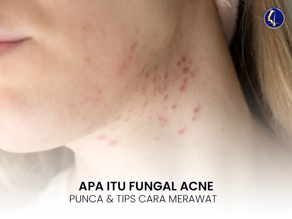 Apa Itu Fungal Acne? Punca, Tanda & Cara Merawat Untuk Kulit Sihat