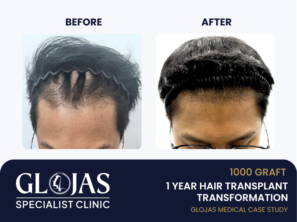 Kajian Kes: Tanam Rambut – 1,000 Graft untuk Lelaki dengan Garis Rambut Surut & Dahi Lebar (Hasil 1 Tahun) 2 tanam-rambut-hasil