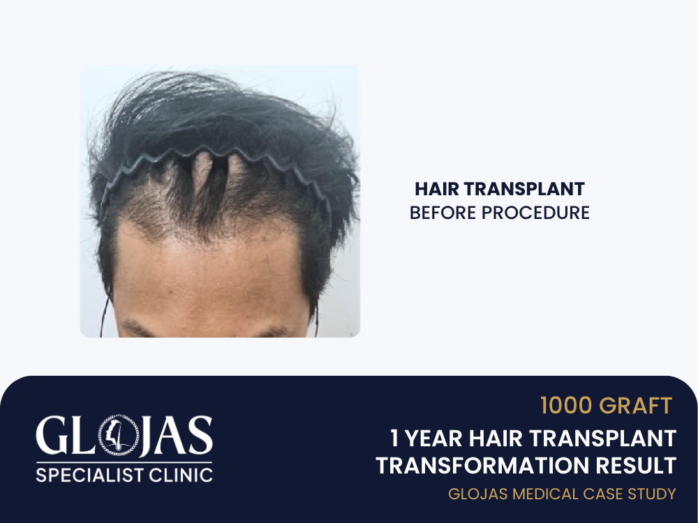 tanam-rambut-sebelum