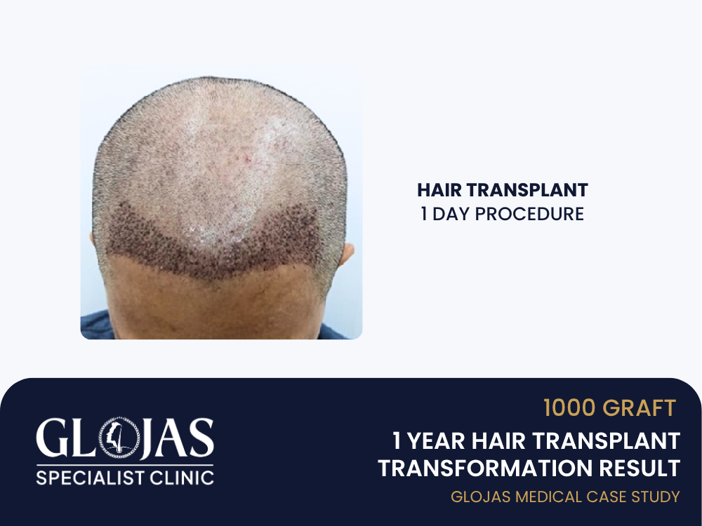 tanam-rambut-hari-1