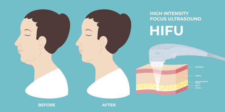 HIFU-facelift-treatment-kuala-lumpur-malaysia